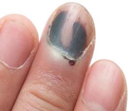 Black nail: how to catch it?