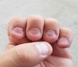 A few tips for stopping nail biting