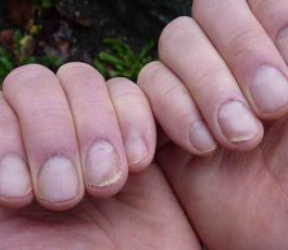 What causes nail psoriasis?