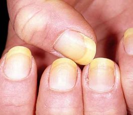 How can nail polish turn nails yellow?